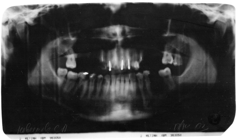 Панорамный снимок челюсти до протезирования
